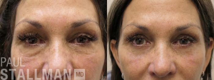 Before & After Blepharoplasty for Women Case 202 Front View in Fresno, Santa Maria, San Luis Obispo, CA