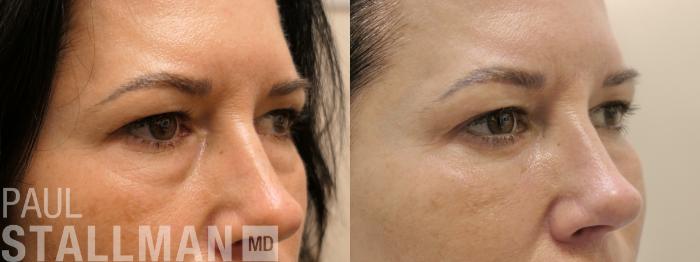 Before & After Blepharoplasty for Women Case 203 Right Oblique View in Fresno, Santa Maria, San Luis Obispo, CA