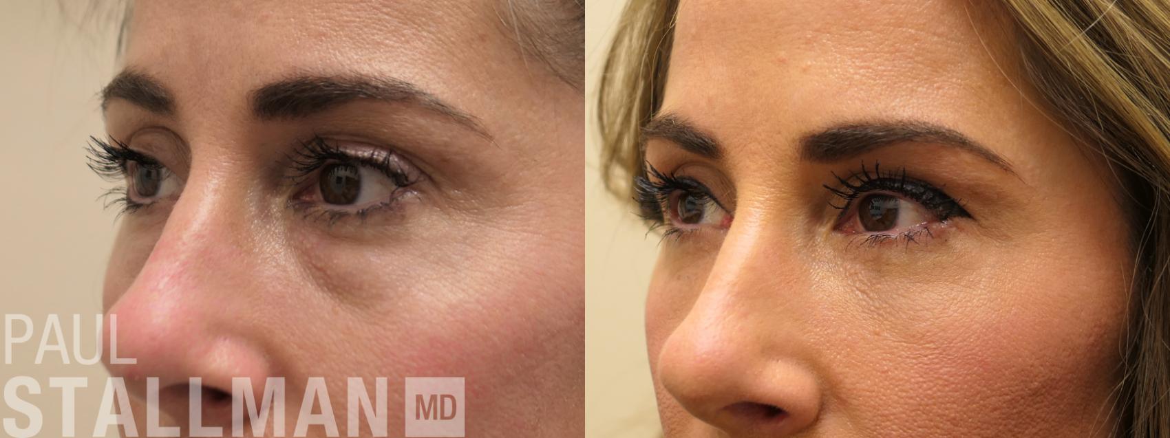 Before & After Blepharoplasty for Women Case 204 Left Oblique View in Fresno, Santa Maria, San Luis Obispo, CA