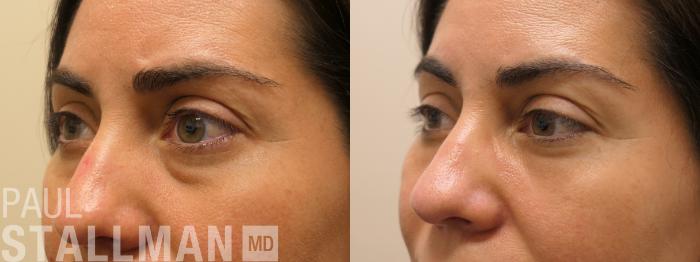 Before & After Blepharoplasty for Women Case 205 Left Oblique View in Fresno, Santa Maria, San Luis Obispo, CA