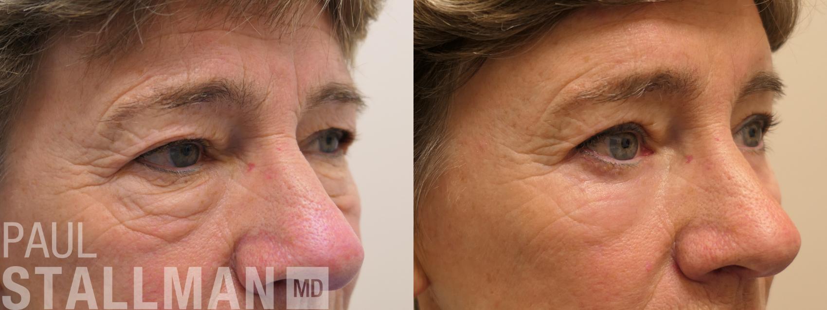 Before & After Blepharoplasty for Women Case 206 Right Oblique View in Fresno, Santa Maria, San Luis Obispo, CA