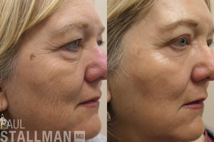 Before & After Blepharoplasty for Women Case 207 Right Oblique View in Fresno, Santa Maria, San Luis Obispo, CA