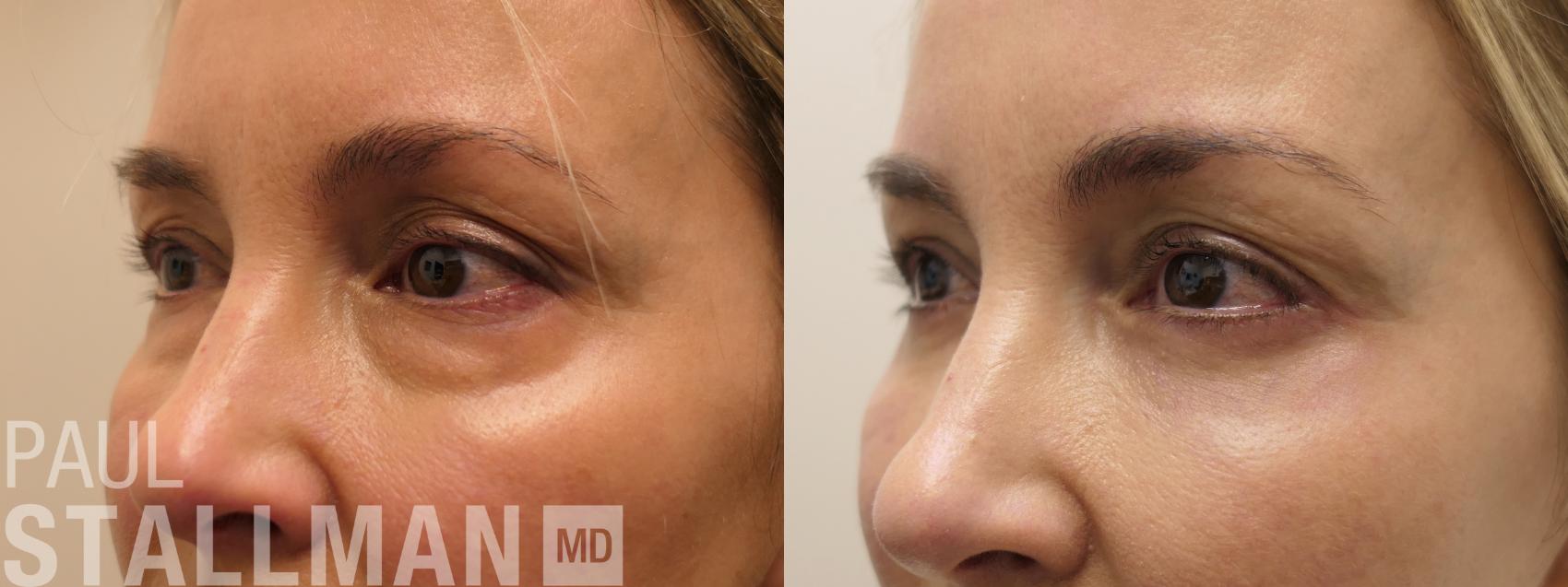 Before & After Blepharoplasty for Women Case 208 Left Oblique View in Fresno, Santa Maria, San Luis Obispo, CA