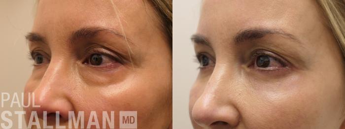 Before & After Blepharoplasty for Women Case 208 Left Oblique View in Fresno, Santa Maria, San Luis Obispo, CA