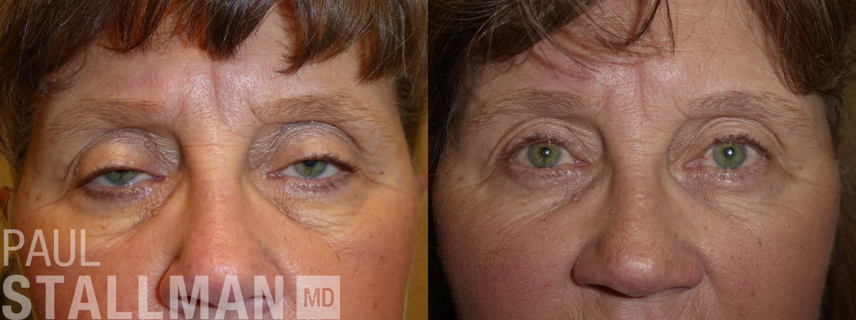 Before & After Blepharoplasty for Women Case 209 Front View in Fresno, Santa Maria, San Luis Obispo, CA