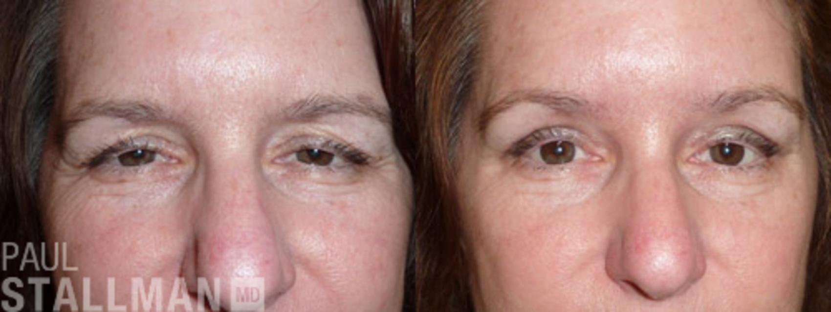 Before & After Blepharoplasty for Women Case 21 View #1 View in Fresno, Santa Maria, San Luis Obispo, CA