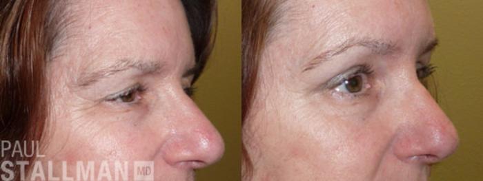 Before & After Blepharoplasty for Women Case 21 View #2 View in Fresno, Santa Maria, San Luis Obispo, CA