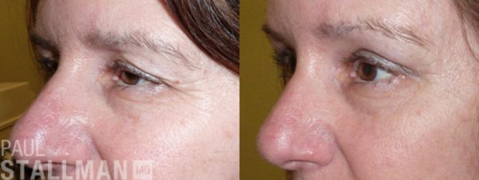 Before & After Blepharoplasty for Women Case 21 View #3 View in Fresno, Santa Maria, San Luis Obispo, CA