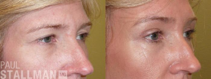 Before & After Blepharoplasty for Women Case 22 View #1 View in Fresno, Santa Maria, San Luis Obispo, CA