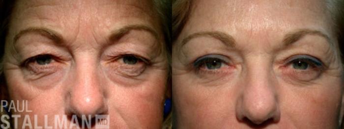 Before & After Blepharoplasty for Women Case 24 View #1 View in Fresno, Santa Maria, San Luis Obispo, CA