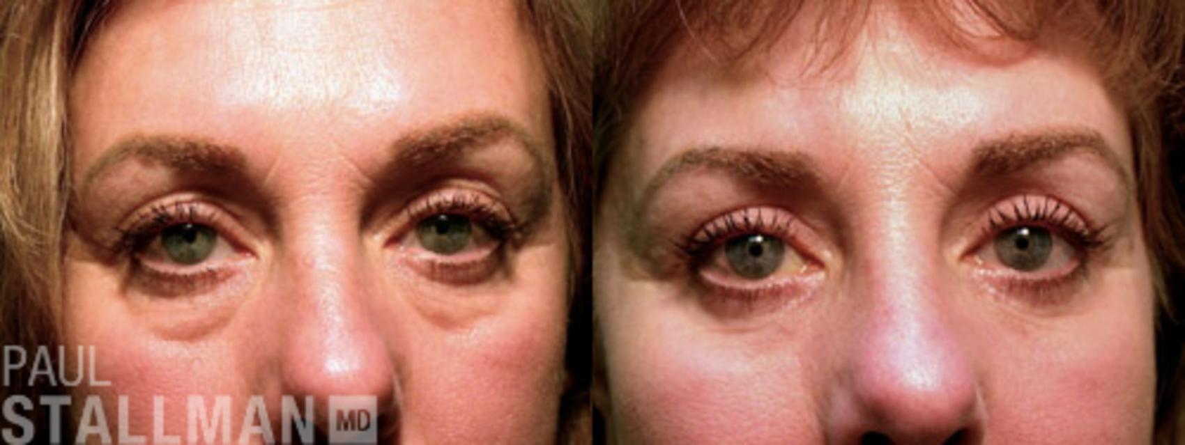 Before & After Blepharoplasty for Women Case 25 View #1 View in Fresno, Santa Maria, San Luis Obispo, CA