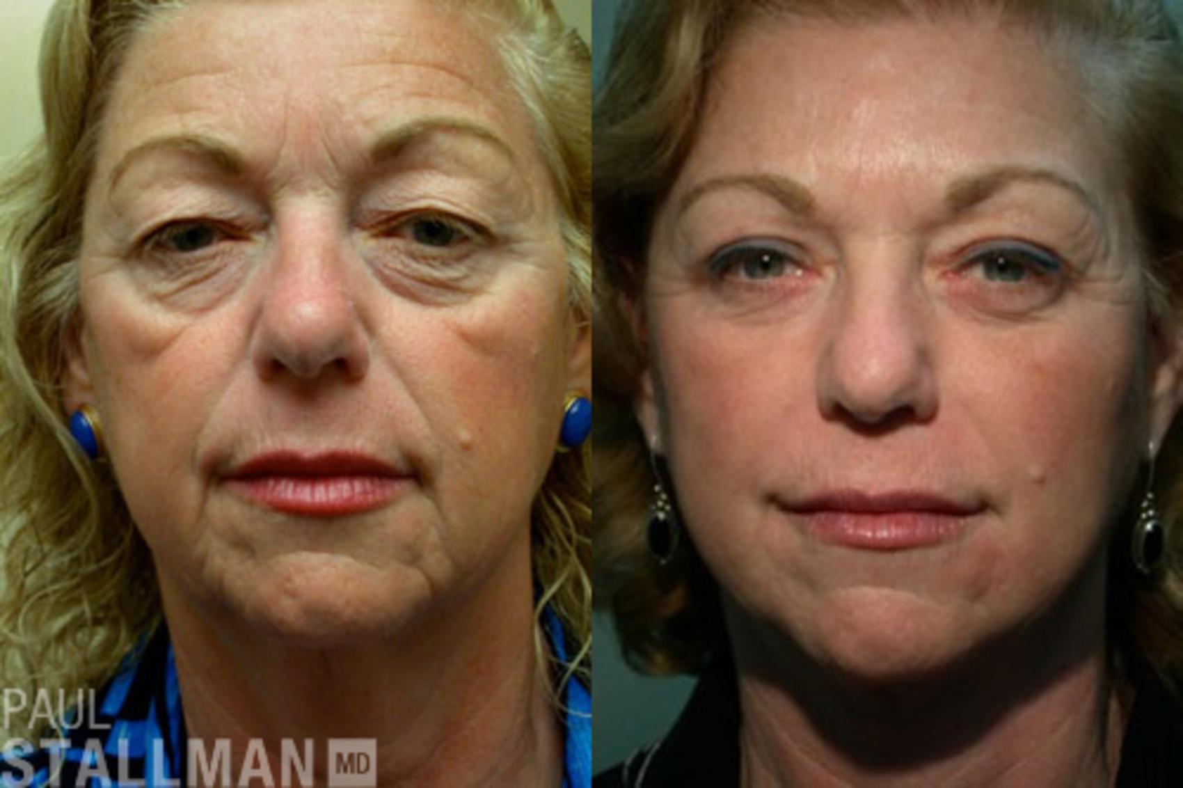 Before & After Blepharoplasty for Women Case 26 View #1 View in Fresno, Santa Maria, San Luis Obispo, CA