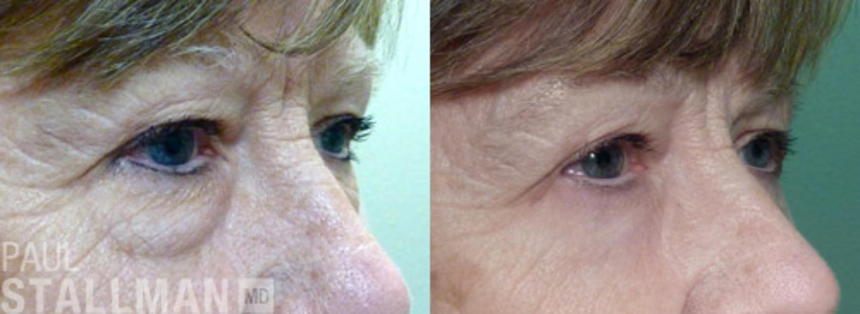 Before & After Blepharoplasty for Women Case 27 View #1 View in Fresno, Santa Maria, San Luis Obispo, CA