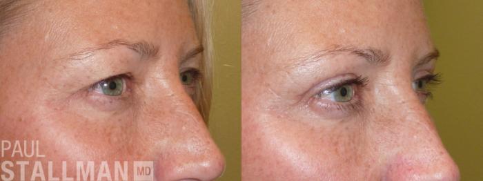 Before & After Blepharoplasty for Women Case 28 View #1 View in Fresno, Santa Maria, San Luis Obispo, CA