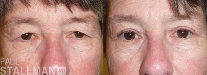 Before & After Blepharoplasty for Women Case 29 View #1 View in Fresno, Santa Maria, San Luis Obispo, CA
