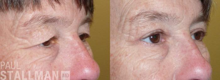 Before & After Blepharoplasty for Women Case 29 View #2 View in Fresno, Santa Maria, San Luis Obispo, CA