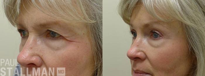 Before & After Blepharoplasty for Women Case 3 View #1 View in Fresno, Santa Maria, San Luis Obispo, CA