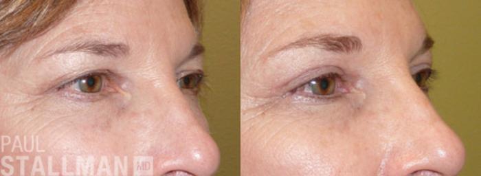 Before & After Blepharoplasty for Women Case 30 View #1 View in Fresno, Santa Maria, San Luis Obispo, CA