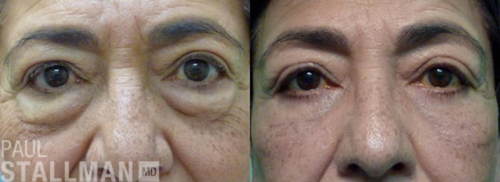 Before & After Blepharoplasty for Women Case 31 View #1 View in Fresno, Santa Maria, San Luis Obispo, CA