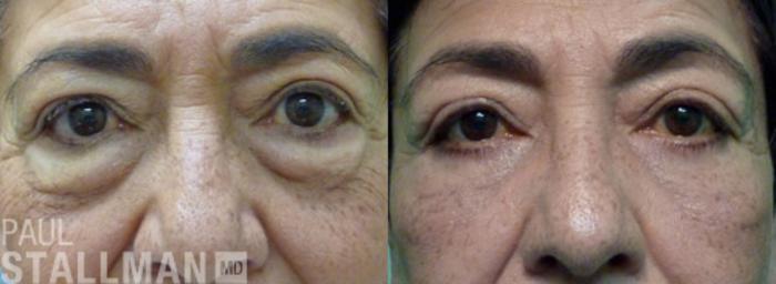 Before & After Blepharoplasty for Women Case 31 View #1 View in Fresno, Santa Maria, San Luis Obispo, CA