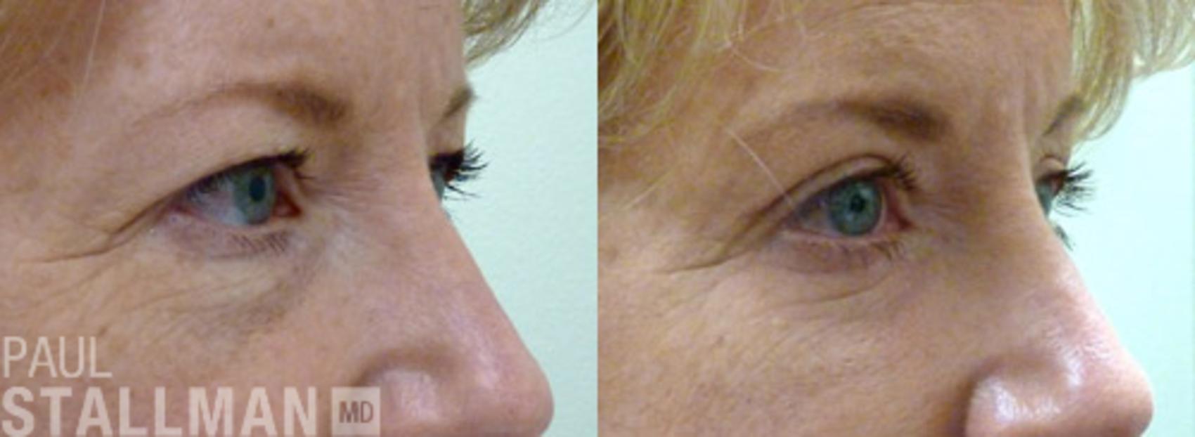 Before & After Blepharoplasty for Women Case 32 View #1 View in Fresno, Santa Maria, San Luis Obispo, CA