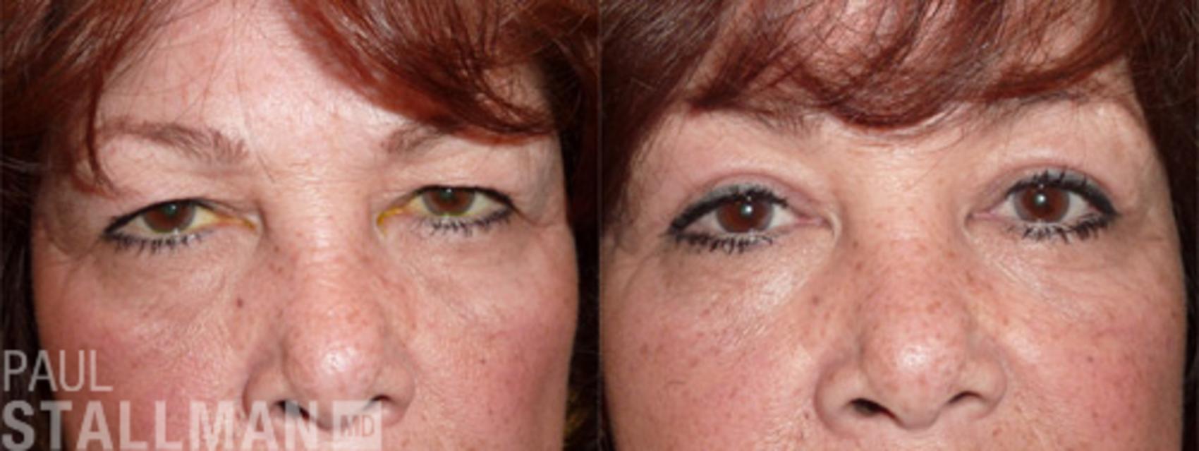 Before & After Blepharoplasty for Women Case 33 View #1 View in Fresno, Santa Maria, San Luis Obispo, CA