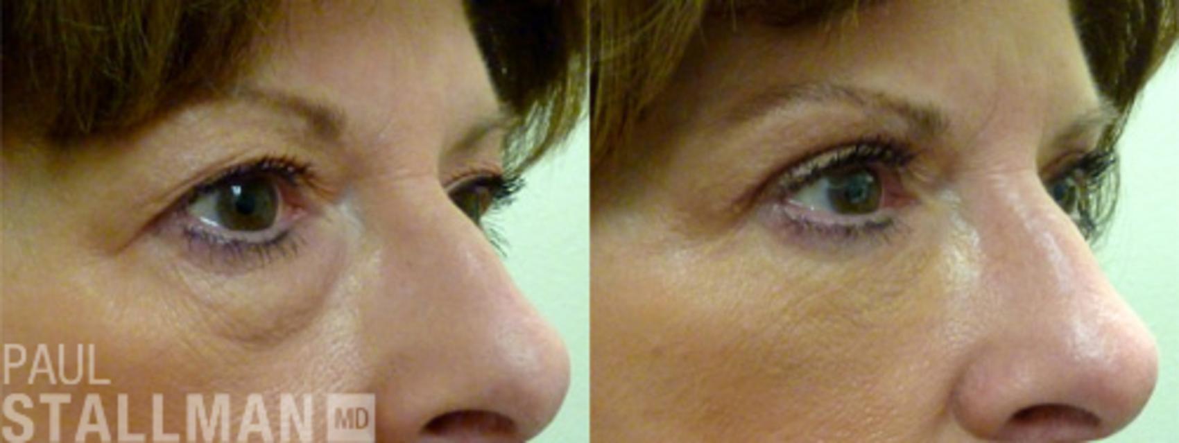 Before & After Blepharoplasty for Women Case 34 View #1 View in Fresno, Santa Maria, San Luis Obispo, CA