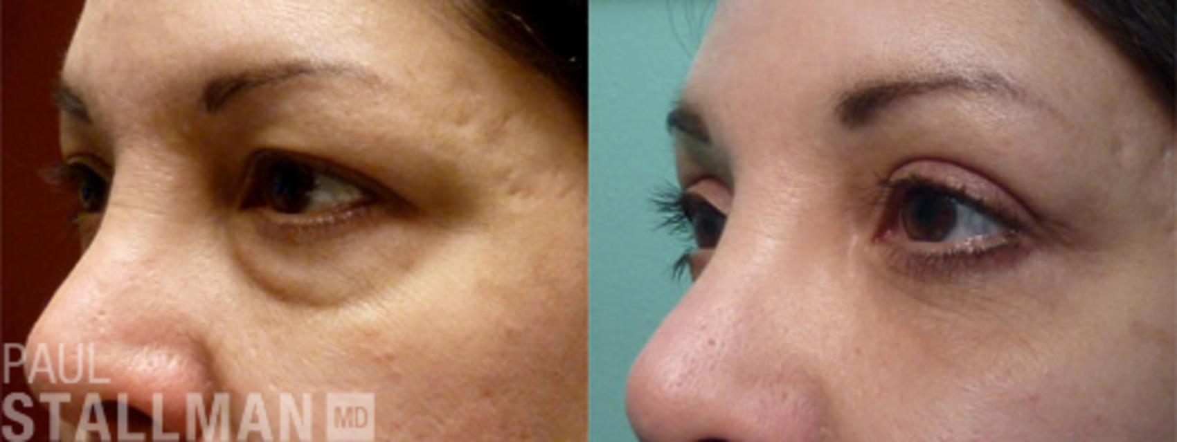 Before & After Blepharoplasty for Women Case 35 View #1 View in Fresno, Santa Maria, San Luis Obispo, CA