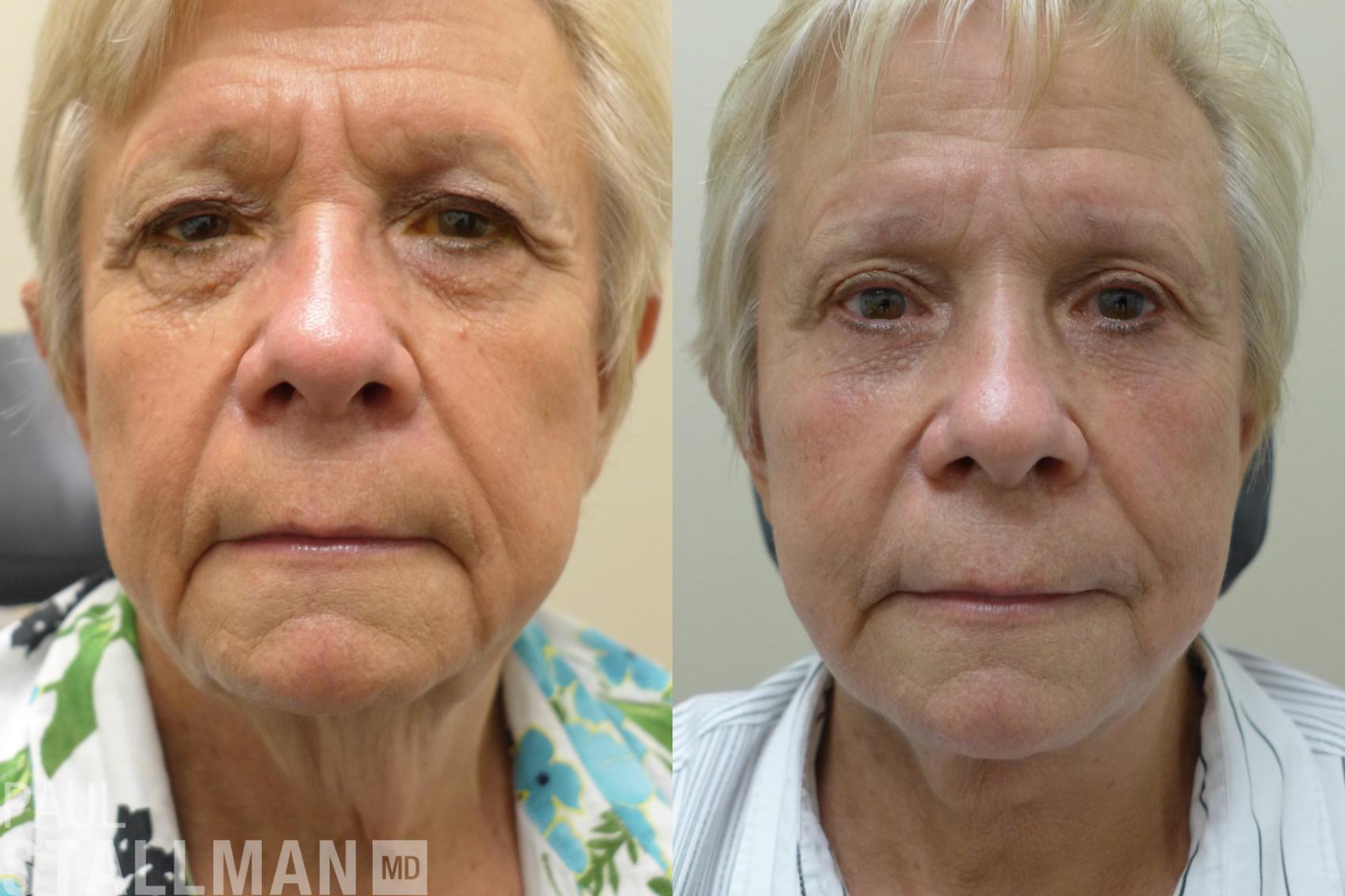 Before & After Blepharoplasty for Women Case 36 View #1 View in Fresno, Santa Maria, San Luis Obispo, CA