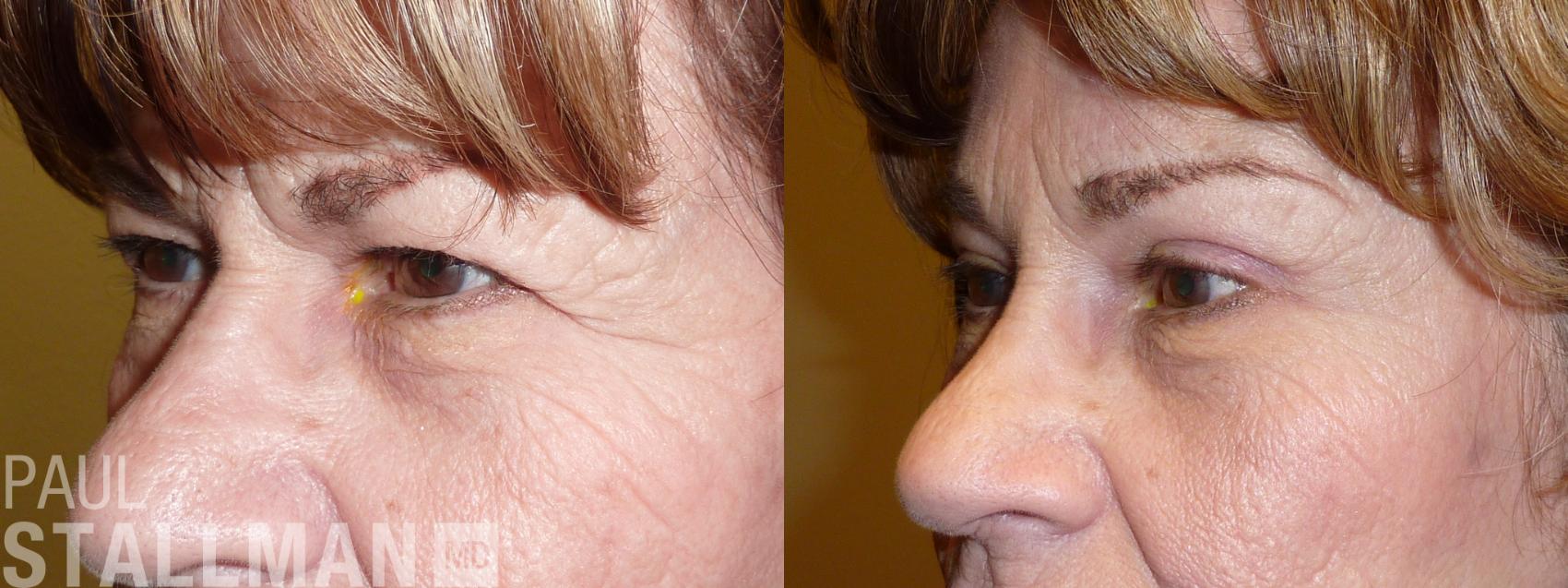 Before & After Blepharoplasty for Women Case 37 View #1 View in Fresno, Santa Maria, San Luis Obispo, CA