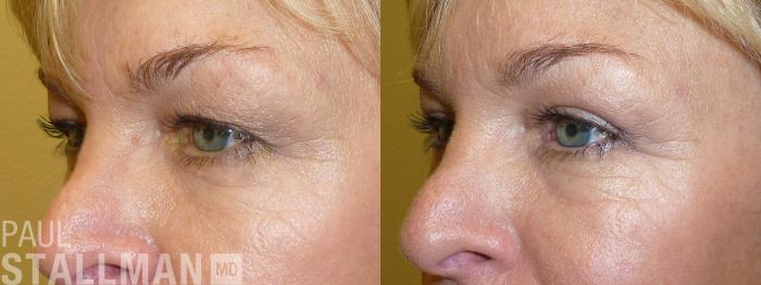 Before & After Blepharoplasty for Women Case 38 View #1 View in Fresno, Santa Maria, San Luis Obispo, CA