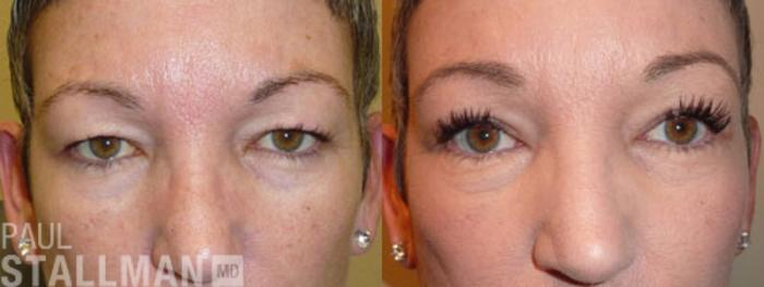 Before & After Blepharoplasty for Women Case 4 View #1 View in Fresno, Santa Maria, San Luis Obispo, CA