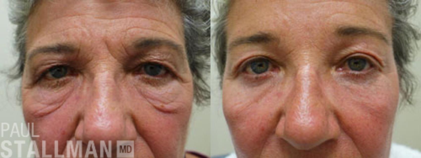 Before & After Blepharoplasty for Women Case 5 View #1 View in Fresno, Santa Maria, San Luis Obispo, CA