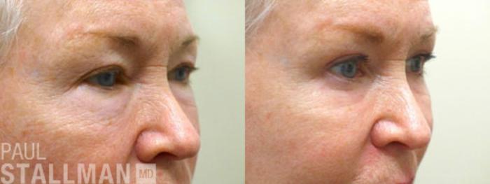 Before & After Blepharoplasty for Women Case 6 View #1 View in Fresno, Santa Maria, San Luis Obispo, CA