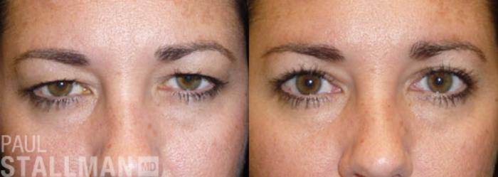 Before & After Blepharoplasty for Women Case 7 View #1 View in Fresno, Santa Maria, San Luis Obispo, CA