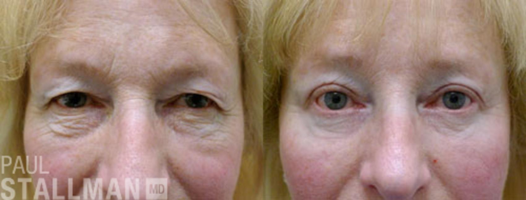 Before & After Blepharoplasty for Women Case 8 View #1 View in Fresno, Santa Maria, San Luis Obispo, CA