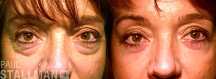 Before & After Blepharoplasty for Women Case 9 View #1 View in Fresno, Santa Maria, San Luis Obispo, CA