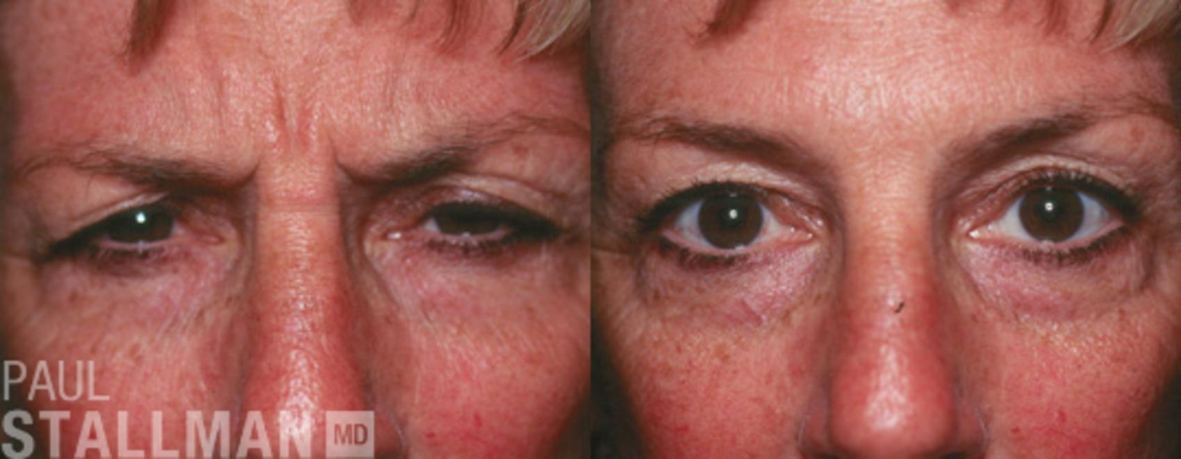 Before & After BOTOX® Cosmetic Case 53 View #1 View in Fresno, Santa Maria, San Luis Obispo, CA