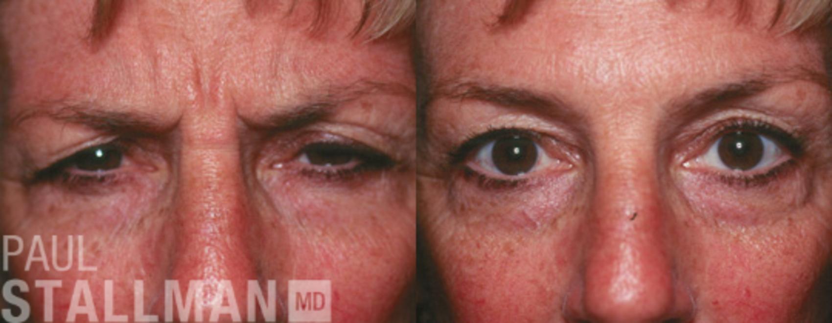 Before & After BOTOX® Cosmetic Case 53 View #1 View in Fresno, Santa Maria, San Luis Obispo, CA