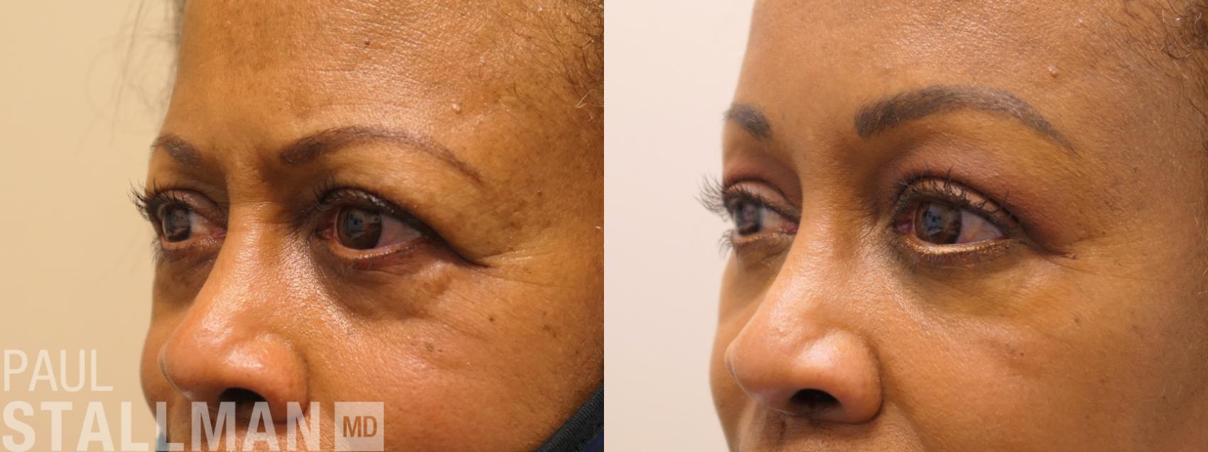 Before & After Blepharoplasty for Women Case 167 Left Oblique View in Fresno, Santa Maria, San Luis Obispo, CA