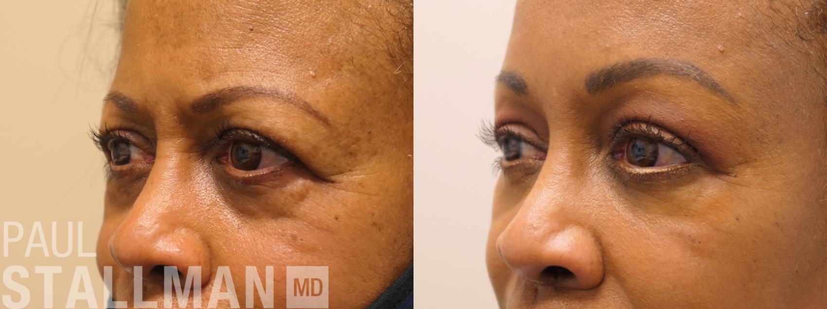 Before & After Blepharoplasty for Women Case 167 Left Oblique View in Fresno, Santa Maria, San Luis Obispo, CA