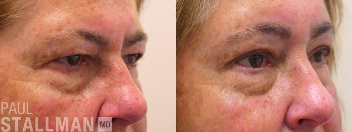 Before & After Blepharoplasty for Women Case 175 Right Oblique View in Fresno, Santa Maria, San Luis Obispo, CA