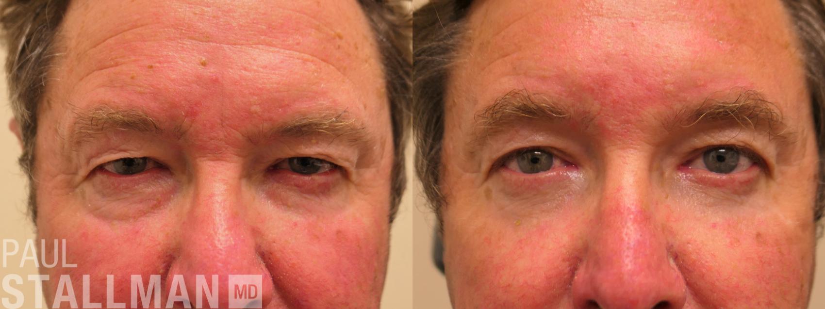 Before & After Brow Lift Case 182 Front View in Fresno, Santa Maria, San Luis Obispo, CA