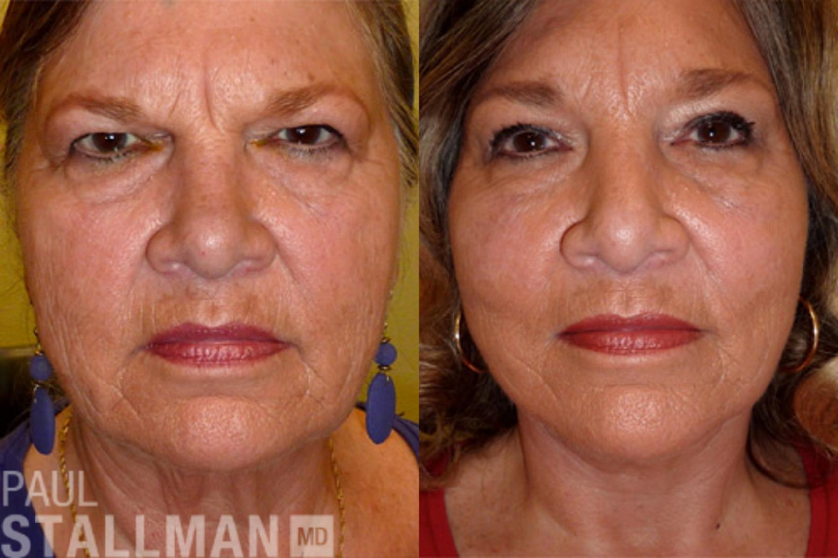 Before & After Brow Lift Case 68 View #1 View in Fresno, Santa Maria, San Luis Obispo, CA