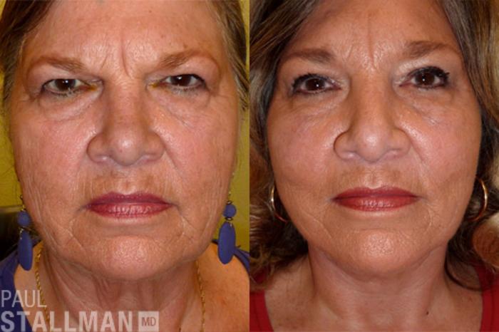 Before & After Face Lift Case 68 View #1 View in Fresno, Santa Maria, San Luis Obispo, CA