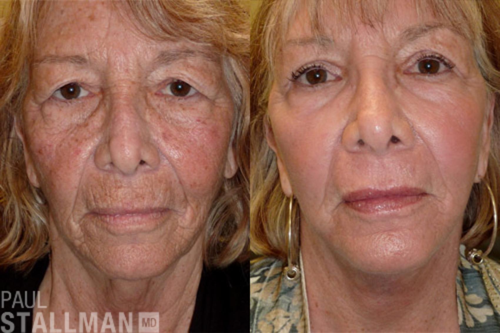 Before & After Face Lift Case 101 View #1 View in Fresno, Santa Maria, San Luis Obispo, CA