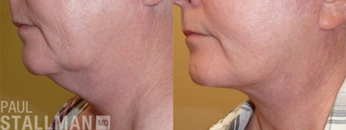 Before & After Face Lift Case 103 View #1 View in Fresno, Santa Maria, San Luis Obispo, CA