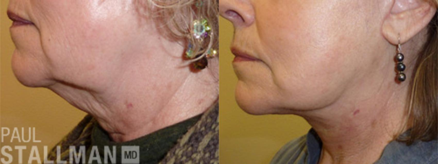Before & After Face Lift Case 105 View #1 View in Fresno, Santa Maria, San Luis Obispo, CA