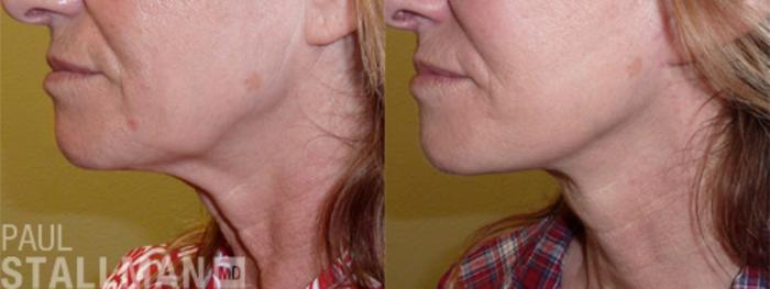 Before & After Face Lift Case 106 View #1 View in Fresno, Santa Maria, San Luis Obispo, CA