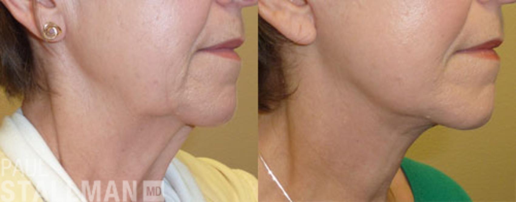 Before & After Face Lift Case 107 View #1 View in Fresno, Santa Maria, San Luis Obispo, CA
